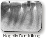 Röntgenbild in Negativ-Darstellung
